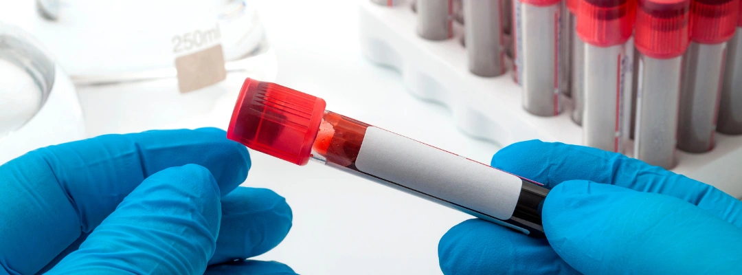 Image of blood test vial for Detecting Wine Consumption