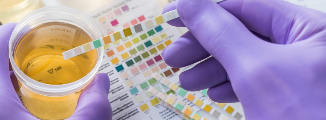 Image of a urine alcohol test kit showing sample container used for EtG and PEth alcohol detection